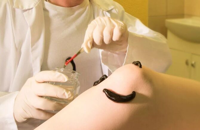 Hirudotherapy για κιρσοί φλέβες