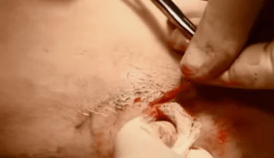 Τύποι επεμβάσεων αφαίρεσης κιρσών